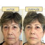 Kit Antiarrugas Dermanix | Tratamiento Coreano